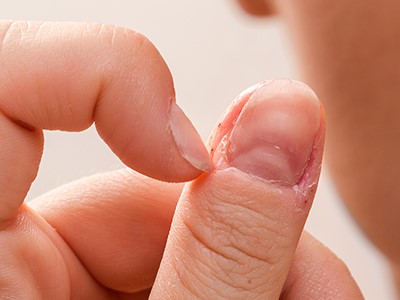 Bavuri: problema mâinilor si unghiilor. Metodele de elimenare